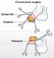 Circumcisio ob religiosas vel medicas causas fit.