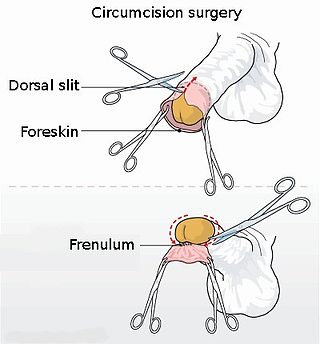 <span class="mw-page-title-main">Circumcision</span> Removal of the human foreskin