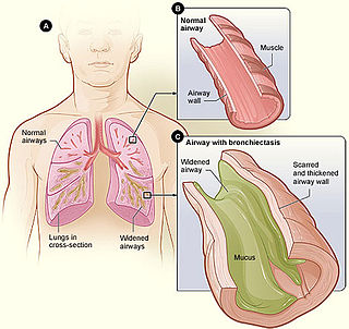 <span class="mw-page-title-main">Bronchiectasis</span> Disease of the lungs