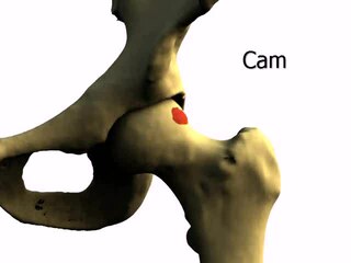 <span class="mw-page-title-main">Femoroacetabular impingement</span> Medical condition