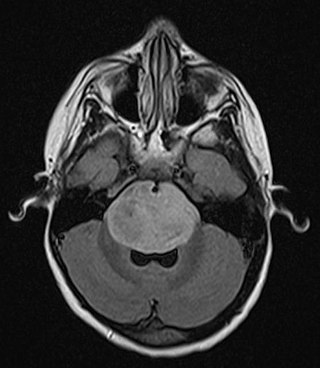 <span class="mw-page-title-main">Brainstem glioma</span> Medical condition