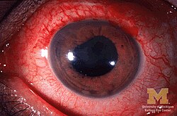 Anterior-uveitis.jpg