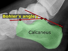 Bohler's angle Bohler's angle (raster).jpg