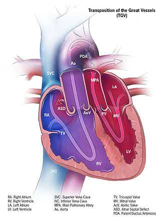 <span class="mw-page-title-main">Transposition of the great vessels</span> Group of congenital heart defects