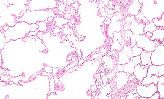 <span class="mw-page-title-main">Respiratory disease</span> Disease of the respiratory system