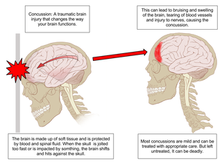 Concussions in rugby union