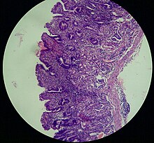 Atroficheskii gastrit.jpg