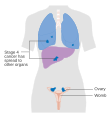 Stage 4 ovarian cancer