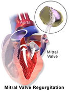 Mitral Valve Regurgitation.png