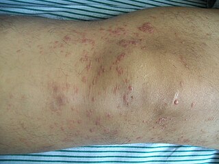 Mycosis fungoides Most common form of cutaneous T-cell lymphoma