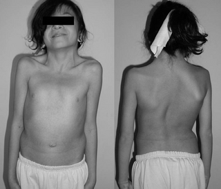 <span class="mw-page-title-main">Noonan syndrome</span> Genetic condition involving facial, heart, blood and skeletal features