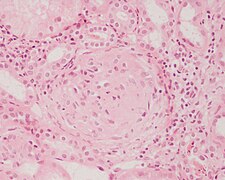 April 25: stain showing signs of Glomerulonephritis