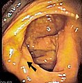 Endoskopska slika slijepog crijeva, sa strelicom koja, u prvom planu, pojazuje ileocekumski zalistak