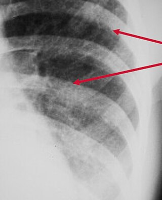 <span class="mw-page-title-main">Peribronchial cuffing</span> Localized patches of lung collapse caused by excess fluid or mucus buildup