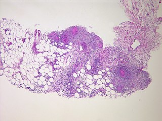 <span class="mw-page-title-main">Peritonitis</span> Inflammation of the inner wall of the abdomen (peritoneum)