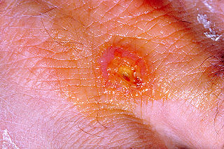 <span class="mw-page-title-main">Tularemia</span> Infectious disease caused by the bacterium Francisella tularensis