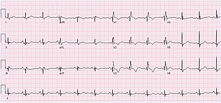 ECG of a 78-year-old female with normal sinus rhythm and right bundle branch block