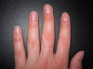 <span class="mw-page-title-main">Nail (anatomy)</span> Hard keratin protection of digit