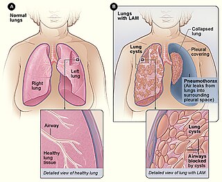 <span class="mw-page-title-main">Lymphangioleiomyomatosis</span> Progressive cystic lung disease