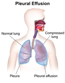 Pleural effusion Blausen 0993 PleuralEffusion.png