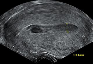 <span class="mw-page-title-main">Hematometra</span> Medical condition