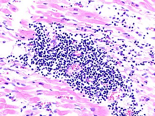 <span class="mw-page-title-main">Myocarditis</span> Inflammation of the heart muscle