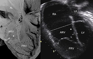 <span class="mw-page-title-main">Ebstein's anomaly</span> Congenital heart defect