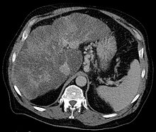 Axial CT showing varices of the fundus in liver cirrhosis with portal hypertension Fundusvarizen.jpg