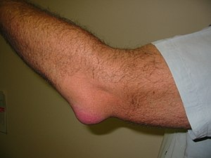 Bursitis Elbow WC.JPG