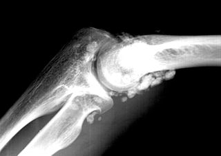 <span class="mw-page-title-main">Synovial chondromatosis</span> Medical condition