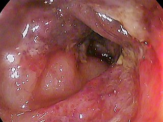 <span class="mw-page-title-main">Ischemic colitis</span> Inflammation of the large intestine due to insufficient blood supply