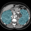 Enlarged kidneys in patient with AML