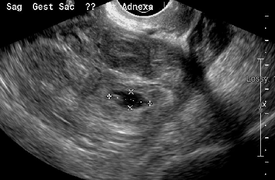 Εικόνα υπερήχου που δείχνει μια έκτοπη κύηση όπου έχει σχηματιστεί ένας σάκος κύησης και έμβρυο.