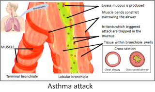 <span class="mw-page-title-main">Asthma</span> Long-term inflammatory disease of the airways of the lungs