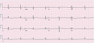 ECG of a 57-year-old male with sinus bradycardia and inferior Q waves