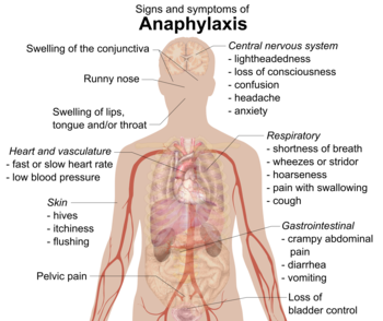 Signs and symptoms of anaphylaxis