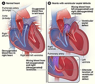 <span class="mw-page-title-main">Congenital heart defect</span> Defect in the structure of the heart that is present at birth