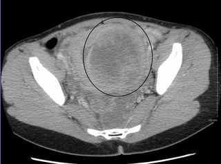 <span class="mw-page-title-main">Pelvic congestion syndrome</span> Medical condition