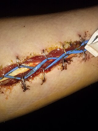 <span class="mw-page-title-main">Compartment syndrome</span> Condition in which increased pressure results in insufficient blood supply