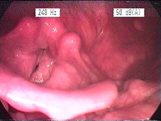 Laryngitis Medical condition