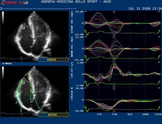 <span class="mw-page-title-main">Strain rate imaging</span>