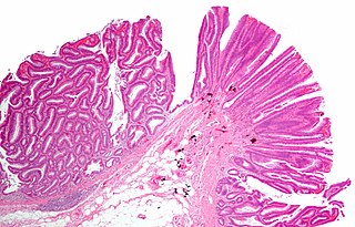 <span class="mw-page-title-main">Colorectal adenoma</span> Medical condition