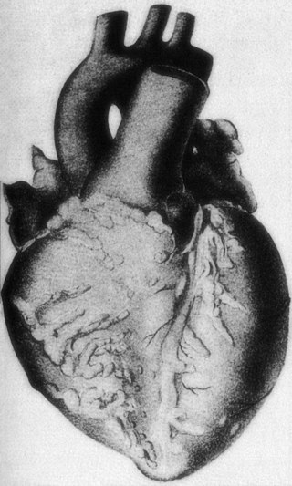 <span class="mw-page-title-main">Polyarteritis nodosa</span> Systemic necrotizing inflammation of medium-sized muscular arteries