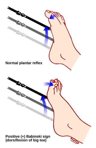 <span class="mw-page-title-main">Plantar reflex</span> Reflex elicited when the sole of the foot is stimulated with a blunt instrument