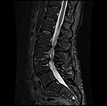 SAGITTAL-FAST-STIR MRI.jpg