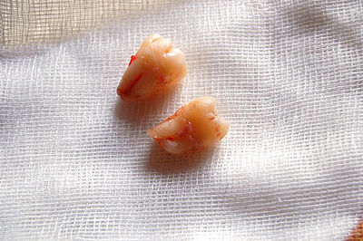 Two extracted wisdom teeth.