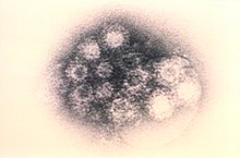 A transmission electron microscopic image depicting virions causing acute hemorrhagic conjunctivitis, primarily caused by two enteroviruses: enterovirus 70, and a variant of coxsackievirus A24. 15281 lores.jpg