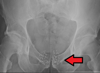 Brachytherapy Type of radiation therapy