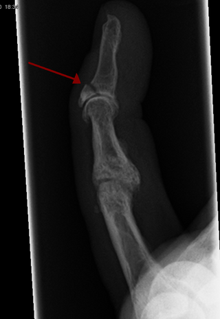 <span class="mw-page-title-main">Broken finger</span> Medical condition