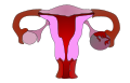 This image depicts a set of ovaries, one of which is normally functioning (left), and healthy, whilst the other one is suffering apoplexy, or the hemorrhaging of an organ. The ovary on the right's surface has been breached, and is bleeding. It has been cut off from the body's supply of nutrients and necrosis has set in. Apoplexy can also happen in the brain and the stomach.